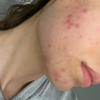 Caudalie Yüzümde Sivilceler Çıktı