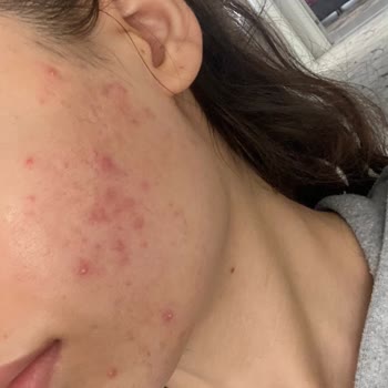 Caudalie Yüzümde Sivilceler Çıktı