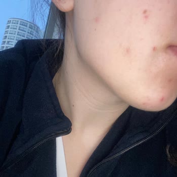 Yves Rocher Bakım Ürünleri Sivilce Çıkarıyor