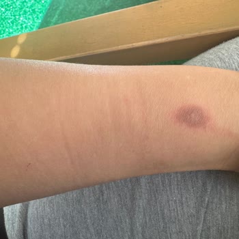 Saida Halidova Güzellik Merkezi Lazer Epilasyon Sorunu