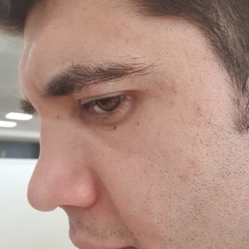 Estethica Atasehir Burun Estetiği Sorunu