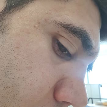 Estethica Atasehir Burun Estetiği Sorunu