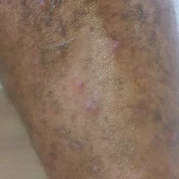 Dirençli Uyuz Salgını, Sağlık Bakanlığı