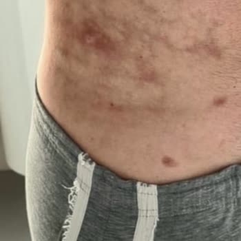 Doç. Dr. Yahya Baltu Hatalı Liposuction Sonrası Nekroz, Derinin Yanması Ve Fibrozis