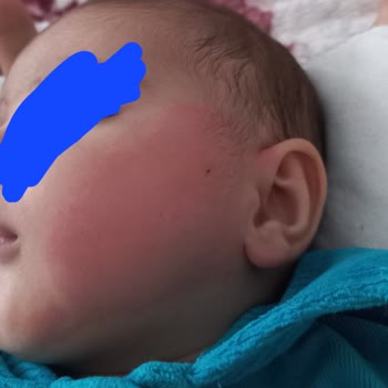 Mustela Stelatopia Bebeğim Yüzünde Alerji Yaptı