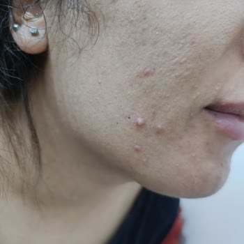 Estee Lauder Cilt Sorunlarına Neden Olan Fondöten Hayal Kırıklığı