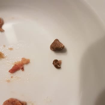 Tamek Barbunya Pilaki İçinden ~1 Cm Çapında Taş Çıktı.