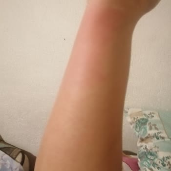 Veet Epilasyon Ürünü Kullanımı Sonrası Ciltte Kızarıklık Ve Kaşıntı