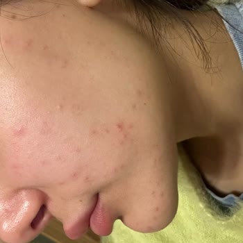 Uzm. Dr. Vildan Hacıfettahoğlu Klinikte Yaşanan Lazer Tedavisi Sonrası Sivilce Problemi