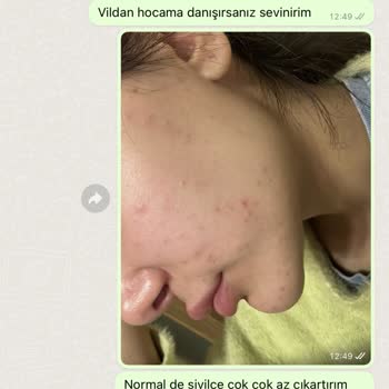 Uzm. Dr. Vildan Hacıfettahoğlu Klinikte Yaşanan Lazer Tedavisi Sonrası Sivilce Problemi