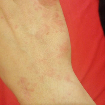 Elidor Saç Kremi Yüzünden Alerji Oldum