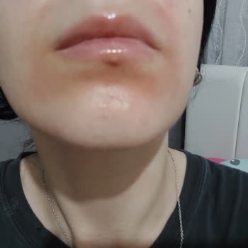 La Roche Posay Temizleme Jeli Yüzümü Yaktı