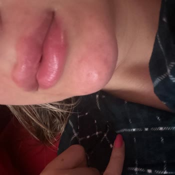 Lami_cosmo Dudak Dolgusu Faciası