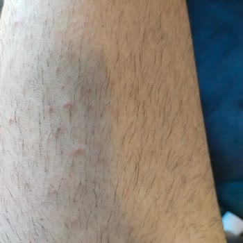 Gratis Cilt Hassasiyetine Dikkat: Ürün Deneyimim