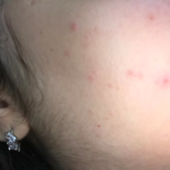 Loreal Güneş Kremi Benim Cildimi Mahvetti