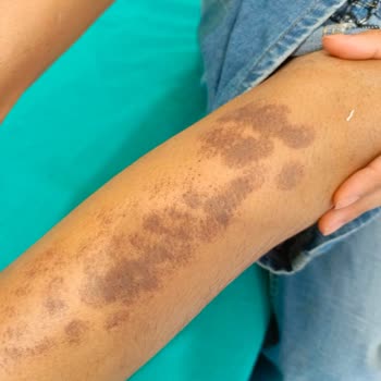 Dünya Klinik Lazer Epilasyon Şikayet