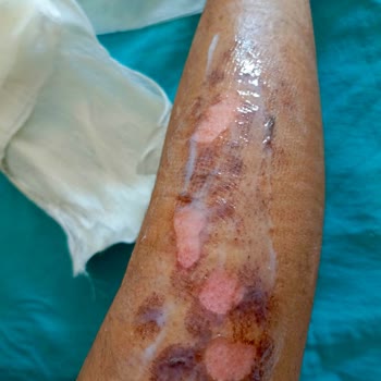Dünya Klinik Lazer Epilasyon Şikayet