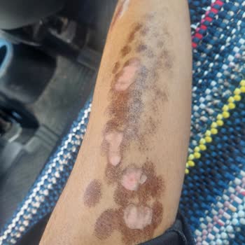 Dünya Klinik Lazer Epilasyon Şikayet