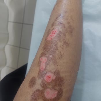 Dünya Klinik Lazer Epilasyon Şikayet