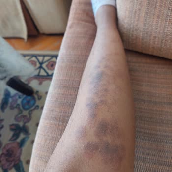 Dünya Klinik Lazer Epilasyon Şikayet