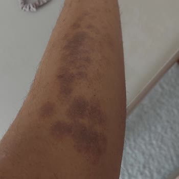 Dünya Klinik Lazer Epilasyon Şikayet