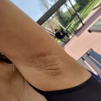 Başak Sönmez Beauty Center Lazer Yaparken Yaktı