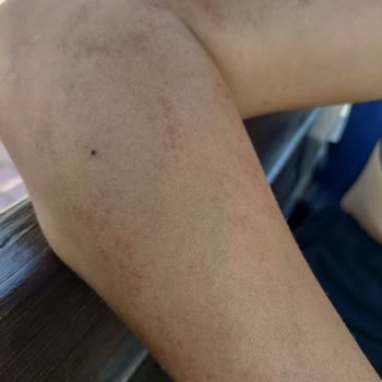 Başak Sönmez Beauty Center Lazer Yaparken Yaktı