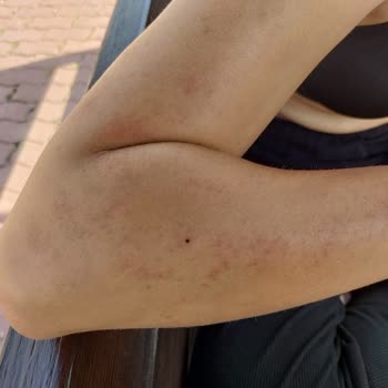 Başak Sönmez Beauty Center Lazer Yaparken Yaktı