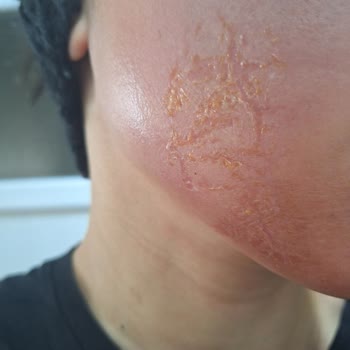 Dilan Polat Estetik Bakırköy'de Yaşanan Uzman Hatası Ve Cilt Sorunları