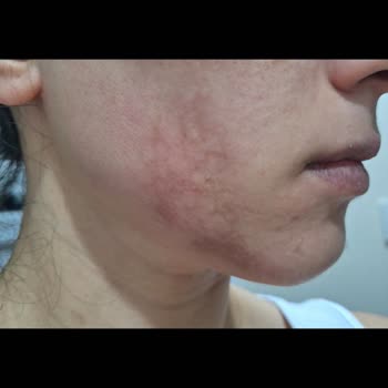 Dilan Polat Estetik Bakırköy'de Yaşanan Uzman Hatası Ve Cilt Sorunları