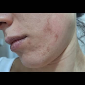 Dilan Polat Estetik Bakırköy'de Yaşanan Uzman Hatası Ve Cilt Sorunları