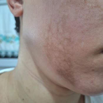 Dilan Polat Estetik Bakırköy'de Yaşanan Uzman Hatası Ve Cilt Sorunları