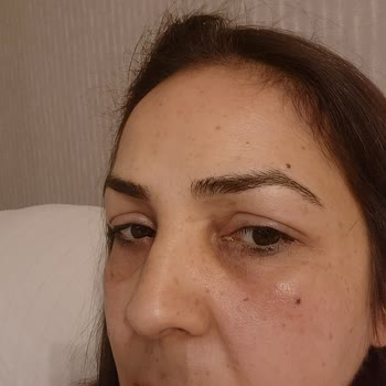 Yves Rocher Göz Altı Ve Serum Alerjisi Hk.