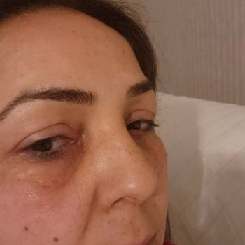 Yves Rocher Göz Altı Ve Serum Alerjisi Hk.