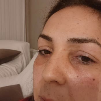 Yves Rocher Göz Altı Ve Serum Alerjisi Hk.