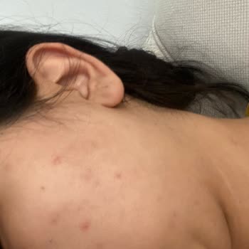 Yves Rocher Ürünü Yüzümde Sivilcelenme Yaptı