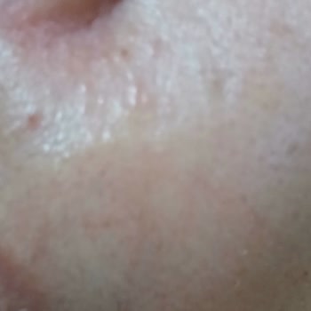 The Purest Solutions Cildimde Komedon Yaptı