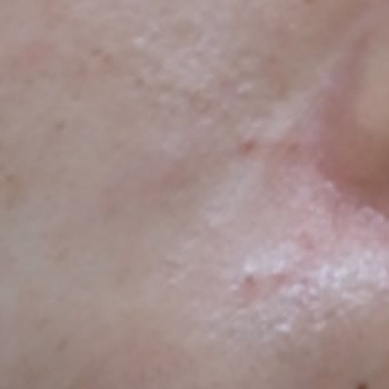 The Purest Solutions Cildimde Komedon Yaptı