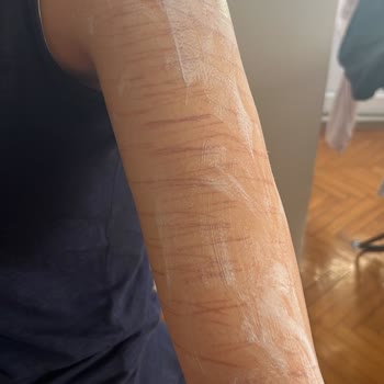 Vip İstanbul Güzellik (Maltepe) Vücutta Yanık Oluştu