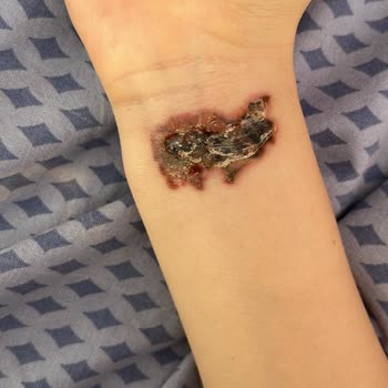 Dela Estetik Dövme Silme İşleminde Enfeksiyon Kaptım!