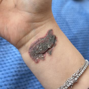 Dela Estetik Dövme Silme İşleminde Enfeksiyon Kaptım!