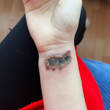 Dela Estetik Dövme Silme İşleminde Enfeksiyon Kaptım!