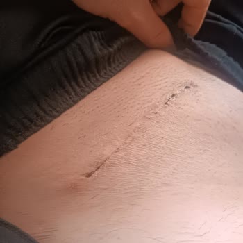 Ameliyat Sonrası Yetersiz İyileşme Süreci Ve İlgisizlik