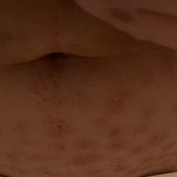 Kurtköy Ersoy Hastanesi Lazerde Cildim Yandı