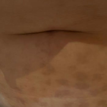 Kurtköy Ersoy Hastanesi Lazerde Cildim Yandı