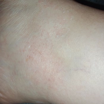 Gratis Ayak Maskesi Alerji Yaptı