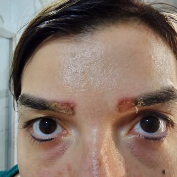 Beautigil Beauty Center Kaşlarımı Lazerle Sildirdim Yandım!