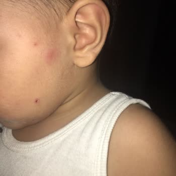 Enterogermina Kids Kırmızı Döküntülere Neden Oldu