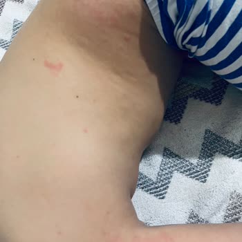 Enterogermina Kids Kırmızı Döküntülere Neden Oldu