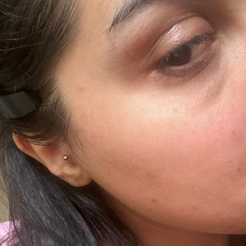 Bakırköy Klinik Göz Altı Işık Dolgusu